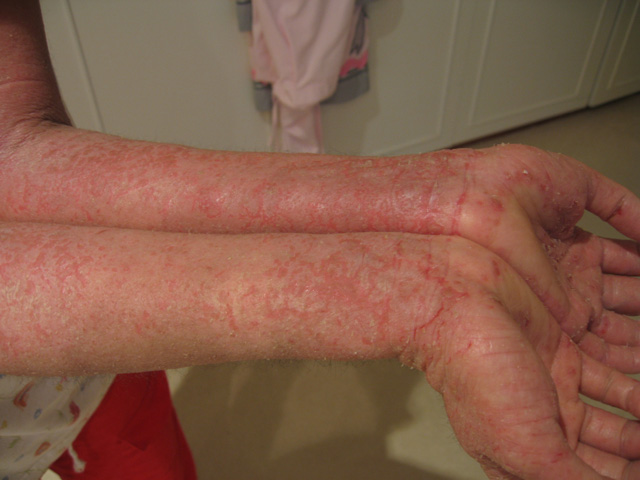Understanding your child’s eczema